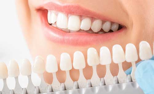 Tooth Colored Cosmetic Fillings