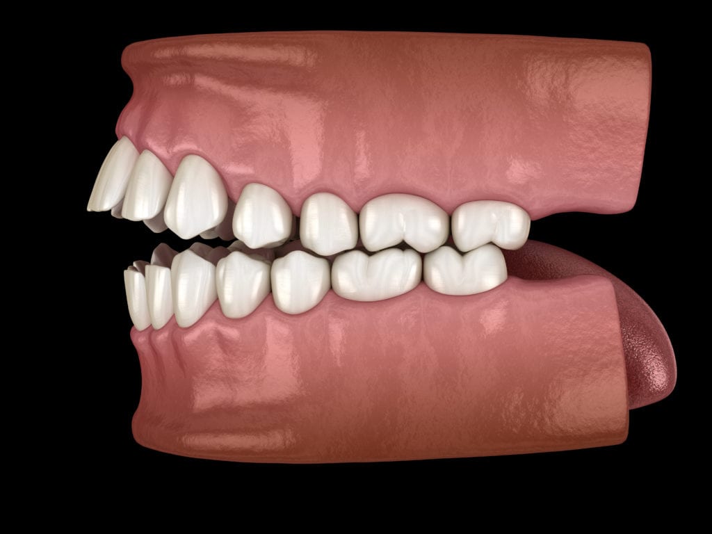 open bite teeth